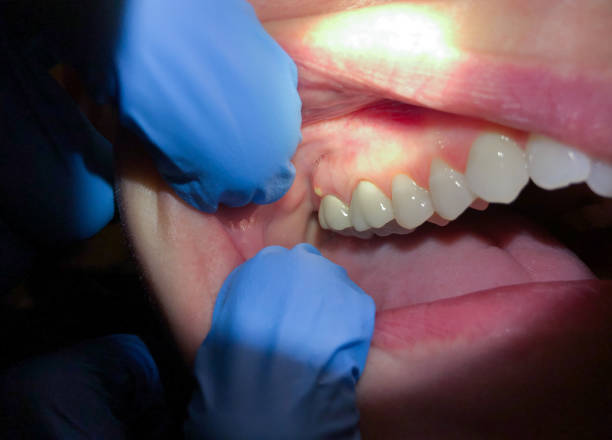 Best Dental Abscess Treatment in Lamar, MO